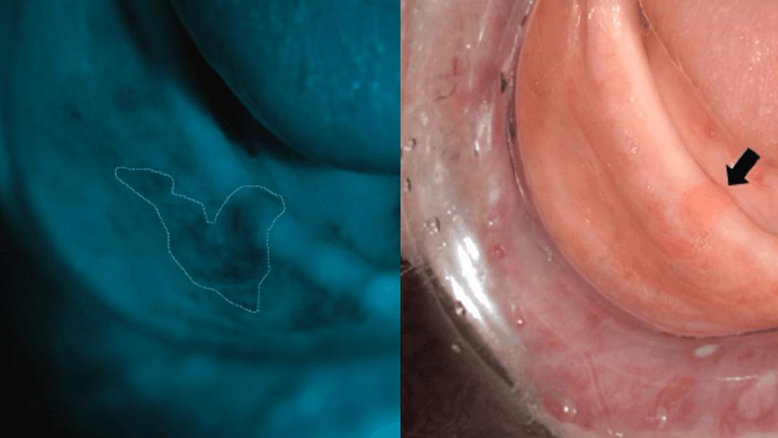 Are You Doing Oral Cancer Screenings?