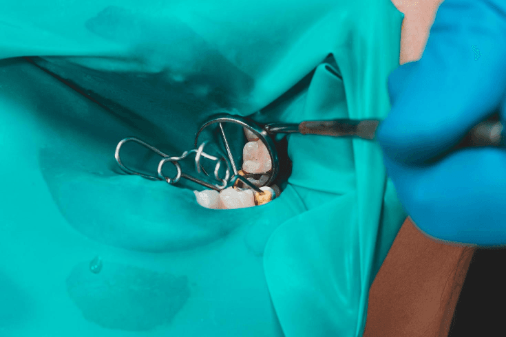 The Rubber Dam Misconception