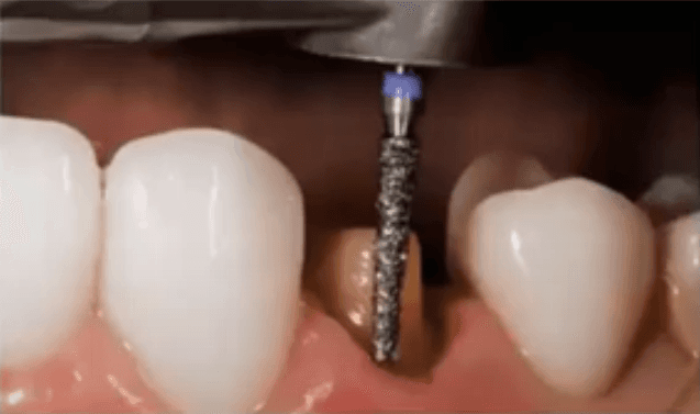 Burs: Advice from an Expert