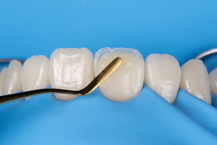 Simplifying Restorative Dentistry with Adaptive Shade Matching Technology