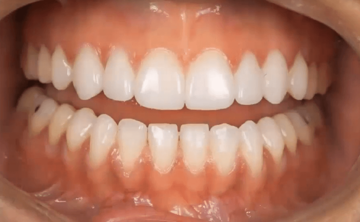 Getting More Confident with Cosmetic Veneer Procedures