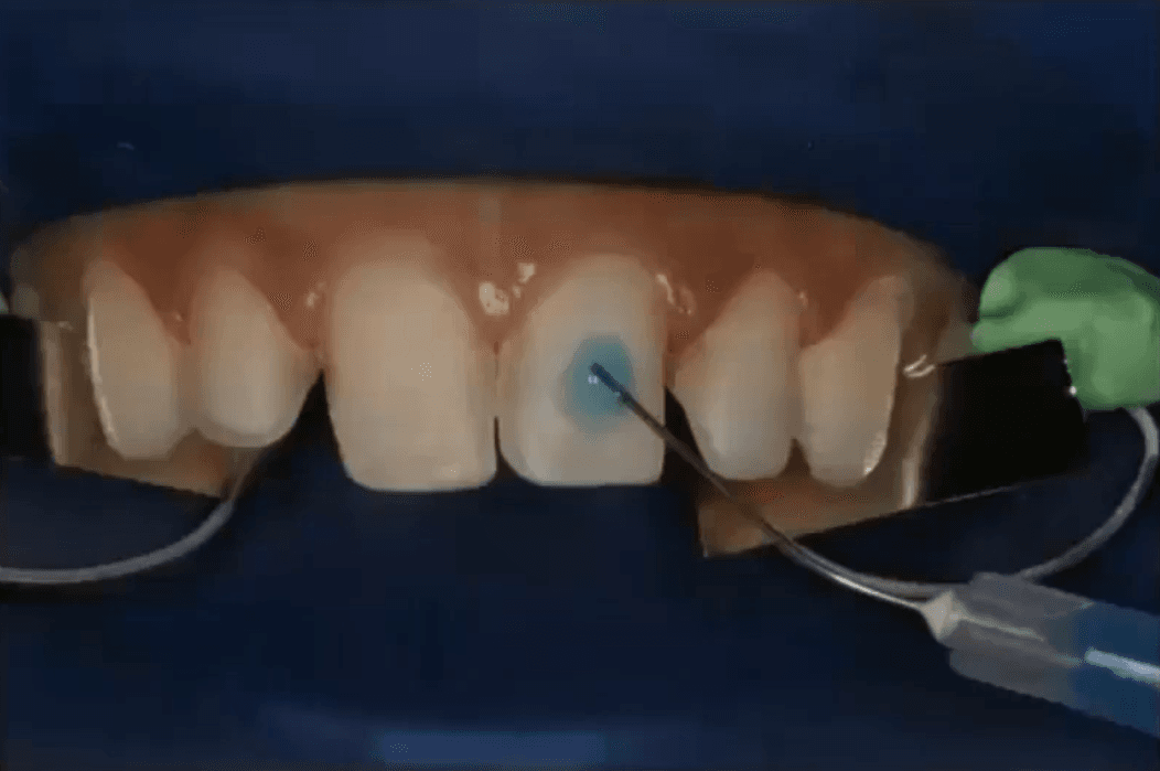 Proven Workflow for Try-In and Cementation of Lithium Disilicate Restorations
