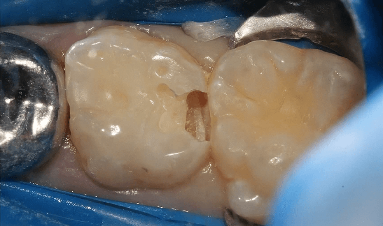 Overcoming Sensitivity with Direct Restoratives