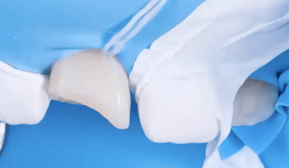 Anterior Direct Composite Restorations: The Ultimate Additive Solution