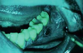 Oral Cancer Exams and Biopsies for the GP