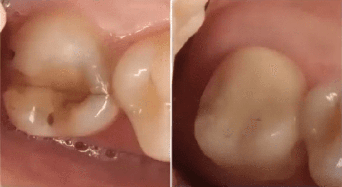 Unlocking Adhesive Excellence in Zirconia Bonding