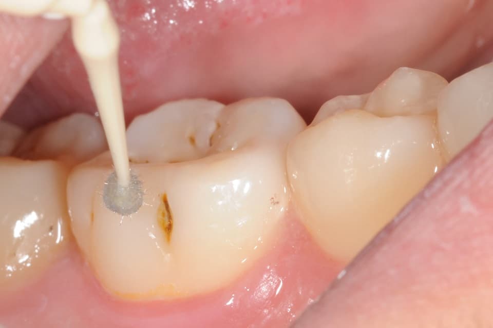 The Most Minimally Invasive Way to Treat Decay